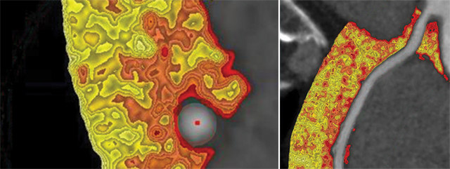 Two images showing artery inflammation