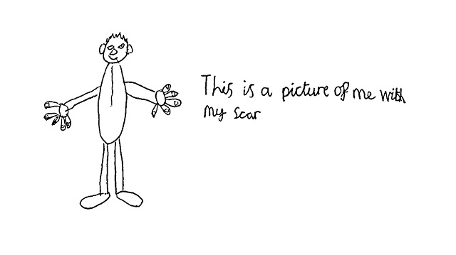 Child's drawing - Child proud of scar