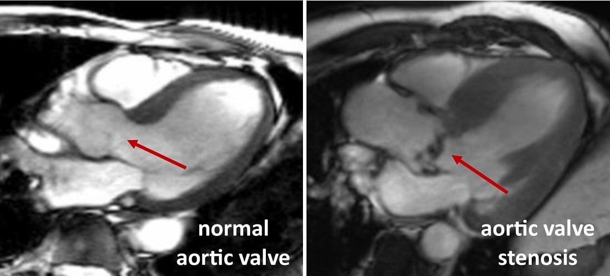 Scientists to test new treatment for heart valve disease BHF