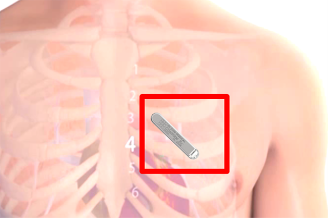 A drawing showing where an implantable cardiac monitor is placed.