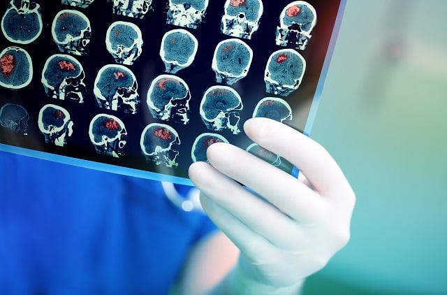 Doctor examining brain scans