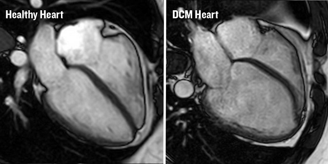 Two MRI scans of hearts. One has dilated cardiomyopathy and the other is a healthy heart.
