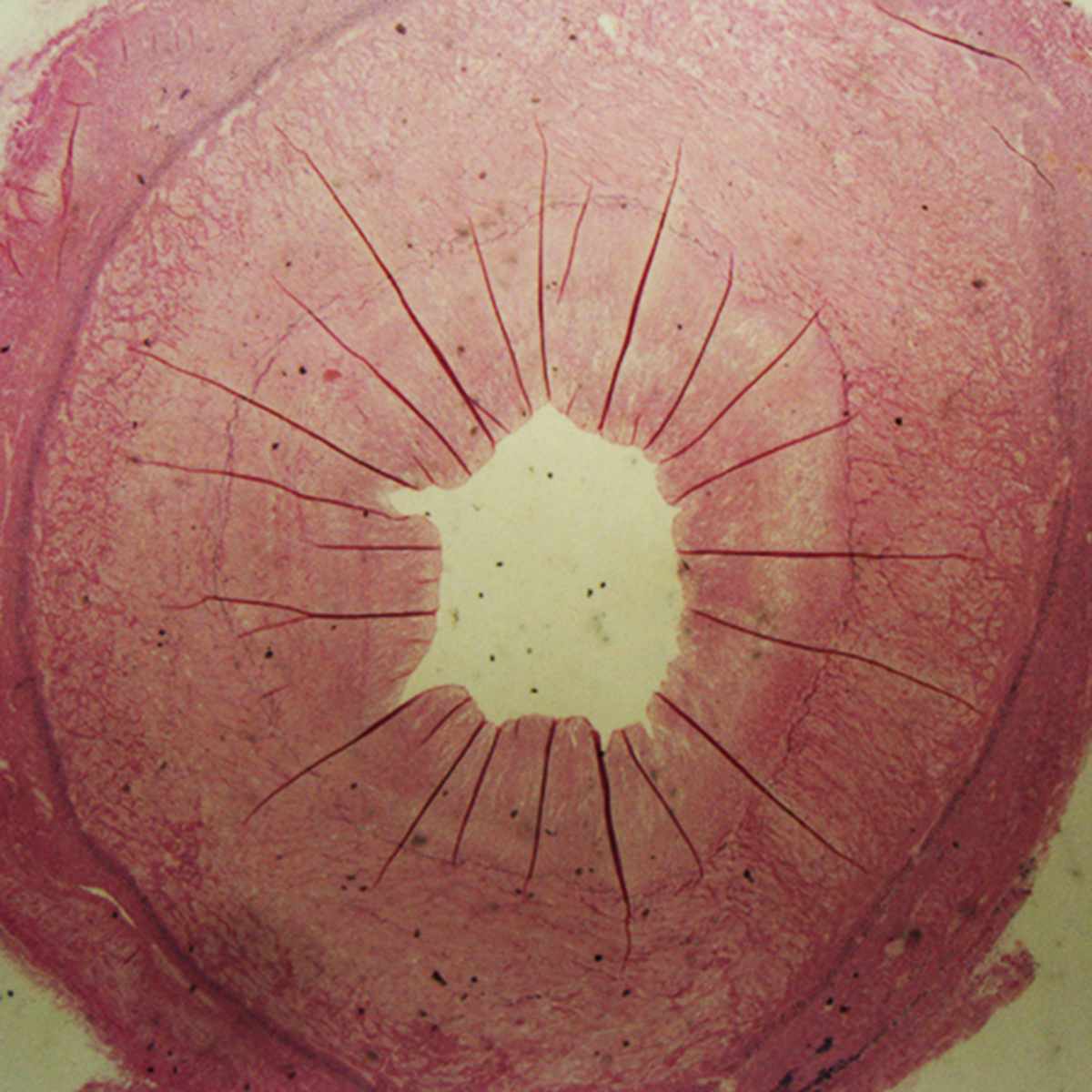 A ring of thickened graft showing how the wall of the vein has narrowed reducing space for the blood in the middle to flow