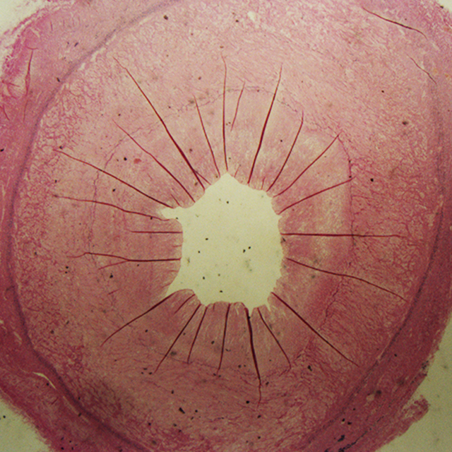 Thickened vein graft