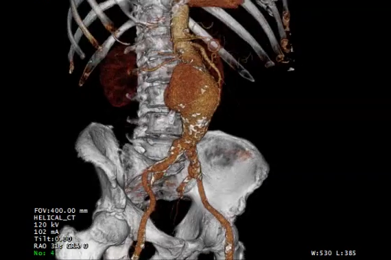 A PET CT image showing an AAA