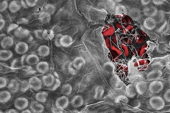 An electron microscope image showing red blood cells trapped in a blood clot by a fibrin biofilm
