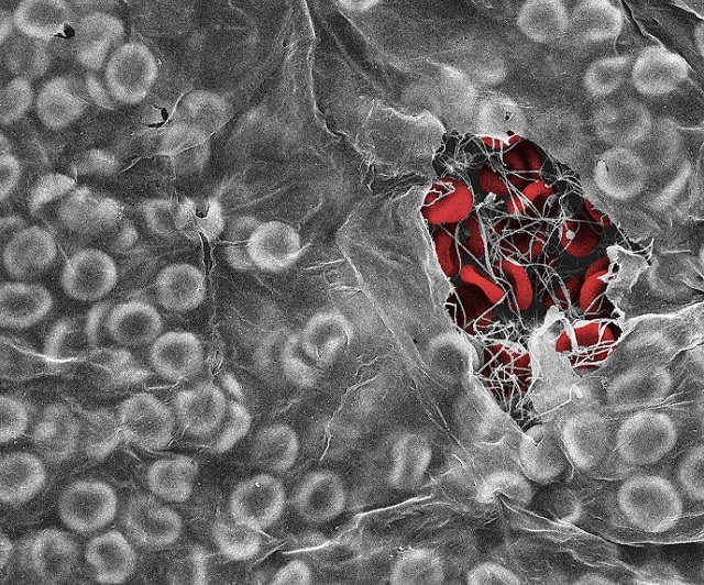An electron microscope image showing red blood cells trapped in a blood clot by a fibrin biofilm