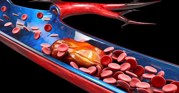 A 3D illustration showing deep vein thrombosis.