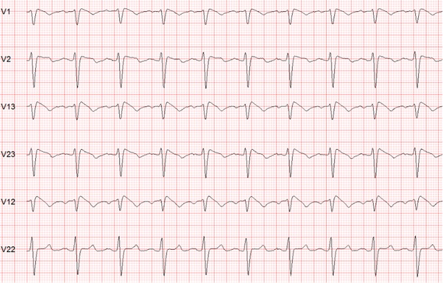 Graph paper with an ECG reading indicating brugada syndrome