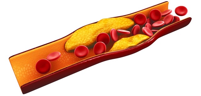 Stylised image of inside and artery with a blockage