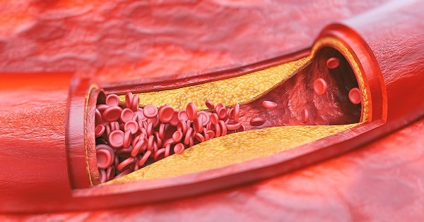 Fatty plaque in artery