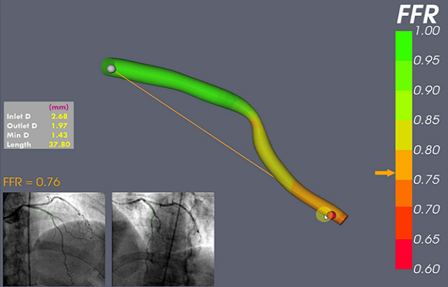 A graphic showing a blood vessel with a healthy pressure shown in green and high blood pressure, which could indicate narrowing of the artery, shown in red