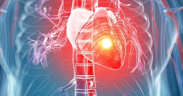 Heart attack 3D image