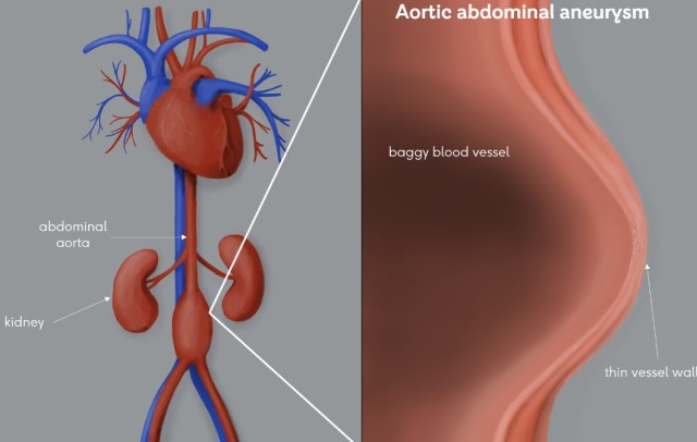 Diagram of abdominal aortic aneurysm