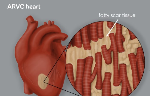Illustration of unhealthy heart tissue