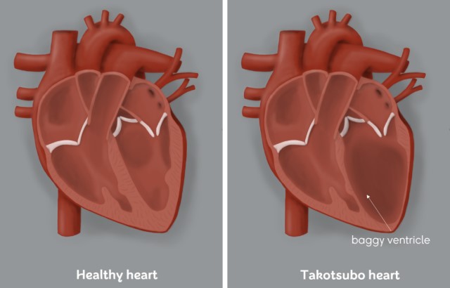 Illustration of heart with Takotsubo