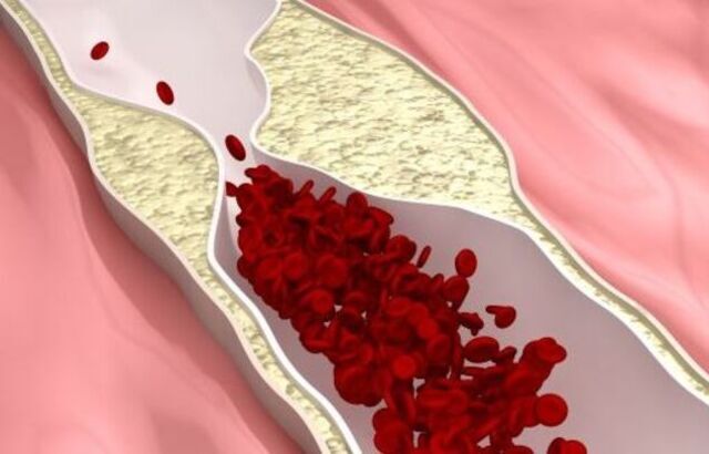 Atheroschlerosis