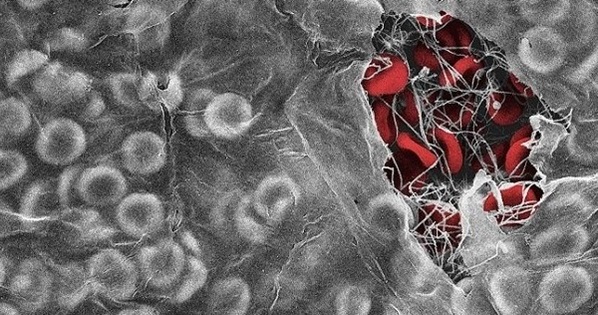 An electron microscope image showing red blood cells trapped in a blood clot by a fibrin biofilm An electron microscope image showing red blood cells trapped in a blood clot by a fibrin biofilm