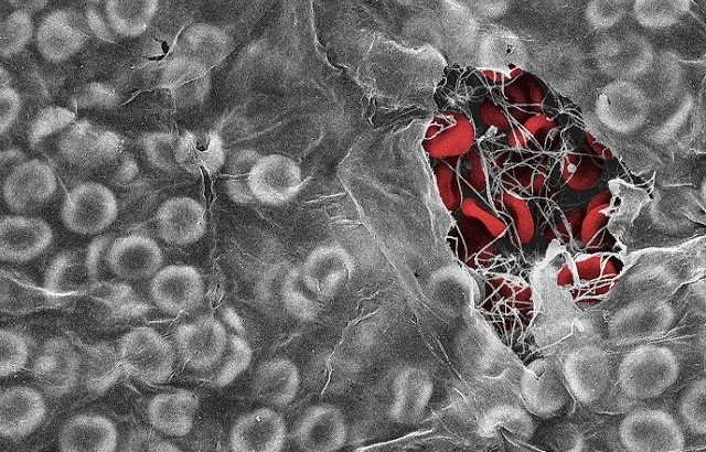 An electron microscope image showing red blood cells trapped in a blood clot by a fibrin biofilm 640 x 410