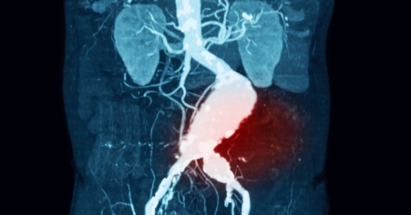 CT scan of someone with an abdominal aortic aneurysm. Their kidneys can be seen towards the top of the image, and below a bulge in the aorta can be seen (highlighted in red)