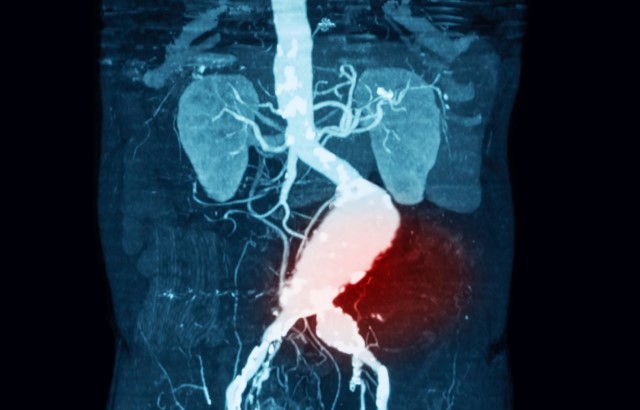 CT scan of someone with an abdominal aortic aneurysm. Their kidneys can be seen towards the top of the image, and below a bulge in the aorta can be seen (highlighted in red)