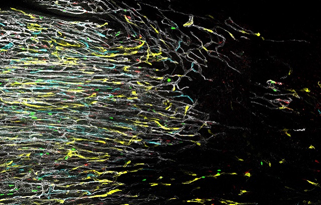Healthy and damaged heart cells after a heart attack