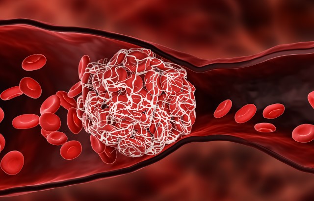 Computer generated image of a blood clot blocking a blood vessel