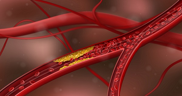 Atherosclerosis