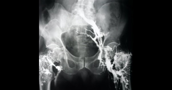 A scan from 1970 which shows the a major blood vessel in the pelvis is blocked, as it is not visible on the scan.