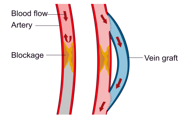Illustration of two arteries with blood flow shown with downward arrows, and yellow clusters labelled blockages. A blue tube around the right artery is labelled vein graft.
