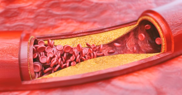 Computer generated image of a blood vessel partially blocked by fatty plaques