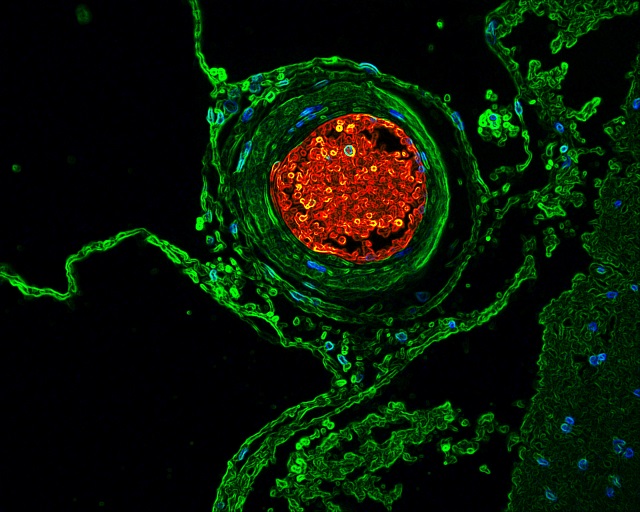 Blood vessel volcano