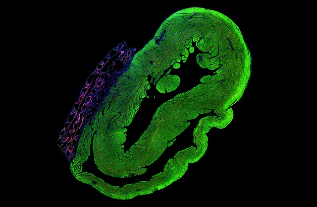 Heart with a cardiac patch