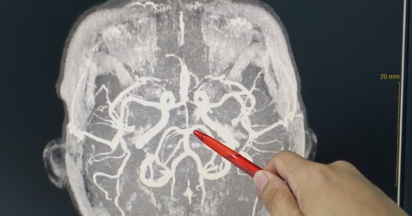 Scan showing the blood vessels of the brain