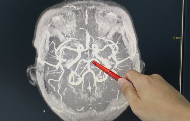 Scan showing the blood vessels of the brain
