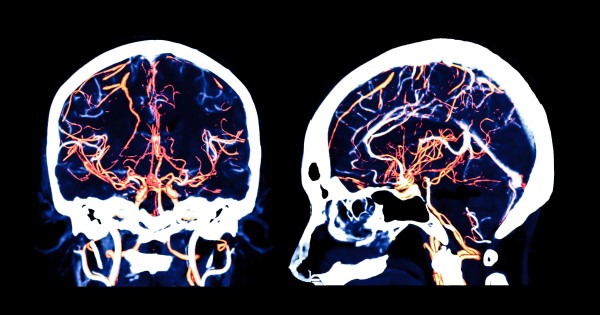A brain scan with blood vessels highlighted