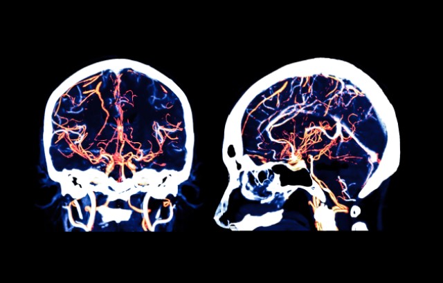A brain scan with blood vessels highlighted