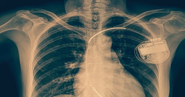 A chest X-ray showing an implantable cardioverter defibrillator