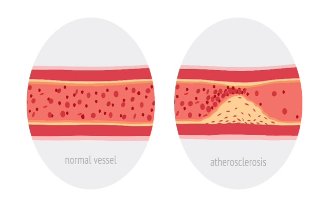 Graphic of a normal vessel beside a graphic of atherosclerosis