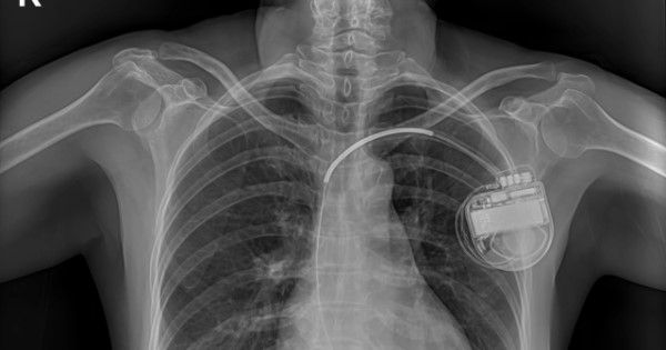 A chest X-ray of someone with an implantable cardioverter defibrillator, showing the device on the upper left side of their chest