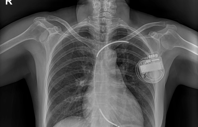 A chest X-ray of someone with an implantable cardioverter defibrillator, showing the device on the upper left side of their chest