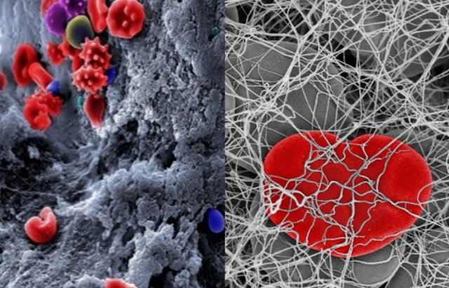 The Clot Thickens & Getting to the Heart of the Matter