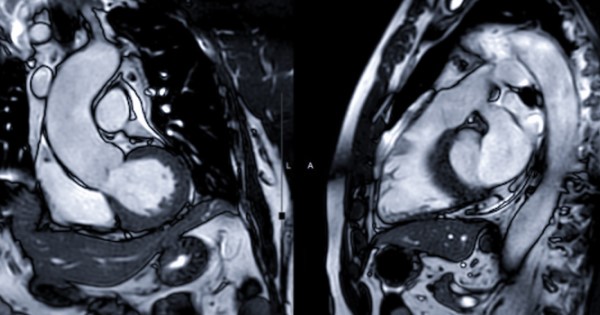 Two MRI scans of a person's chest taken from different angles, showing the heart as well as other organs