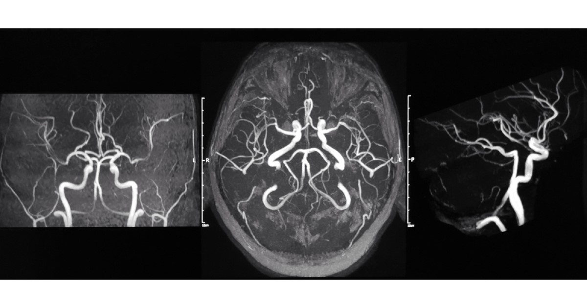 Three different black and white scans showing the blood vessels of the brain from different angles