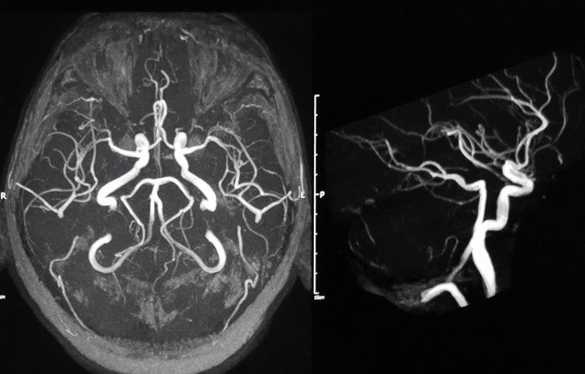 Two black and white brain scans showing the blood vessels of the brain from different angles