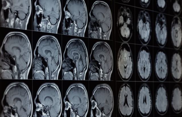 Close of photo of brain MRI scans