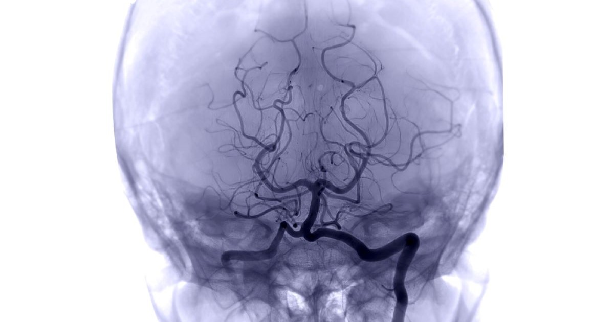 An angiography scan shows the main blood vessels of the brain in dark, with the skull shown in a lighter grey around them