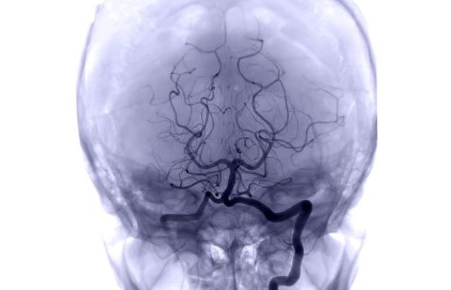 An angiography scan shows the main blood vessels of the brain in dark, with the skull shown in a lighter grey around them