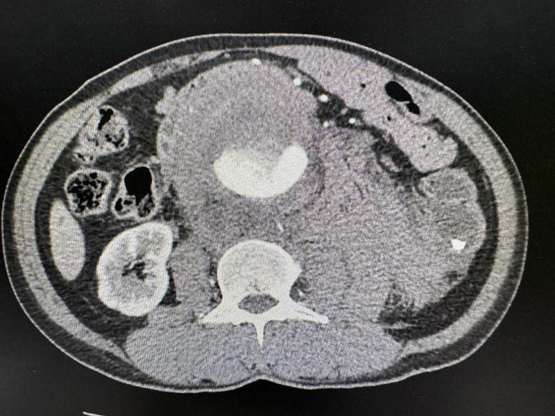 A CT scan showing an abdominal aortic aneurysm from the top down
