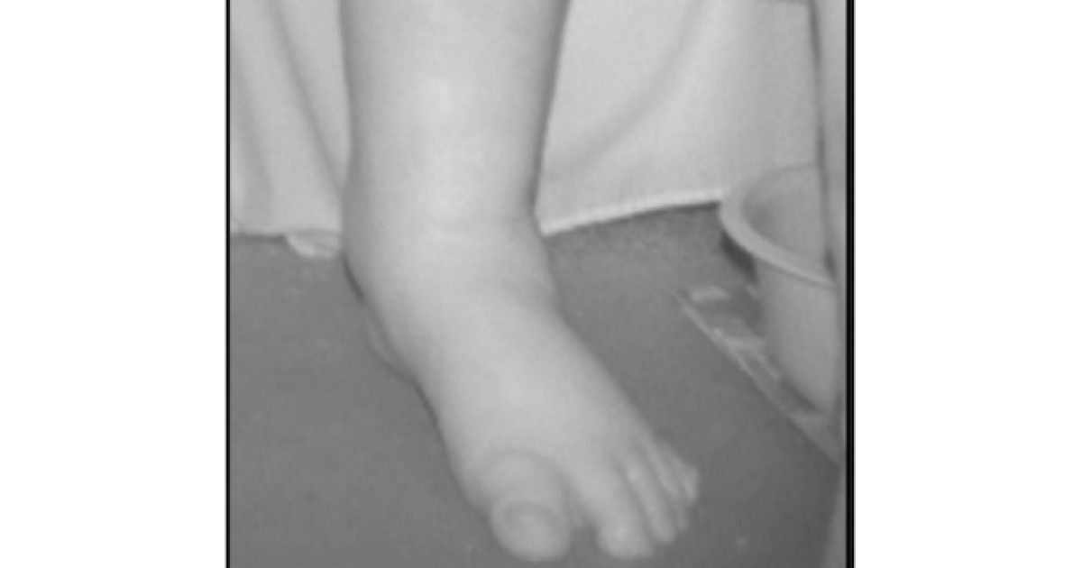 A swollen foot and lower leg detected by the scanner
